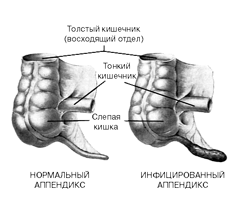 Доклад: Аппендикс и аппендицит