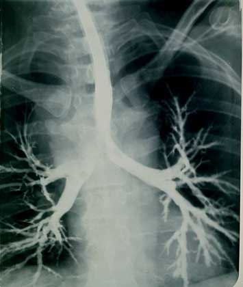ТРАХЕЯ, видная в центре рентгенограммы, разделяется на два главных бронха, ведущих к правому и левому легкому и разветвляющихся на бронхиальное дерево.       IGDA