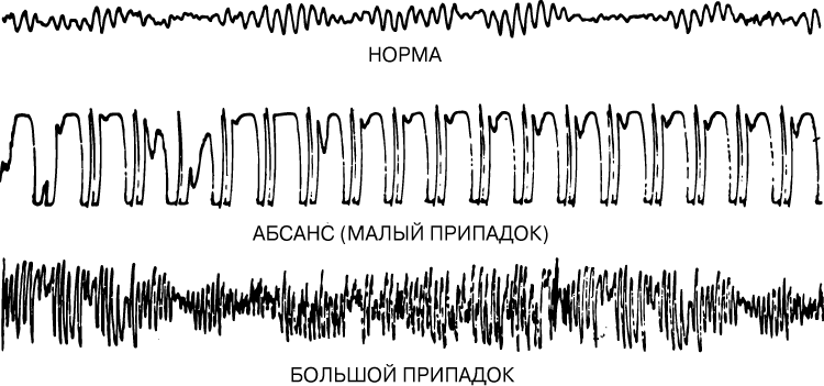 ЭЛЕКТРОЭНЦЕФАЛОГРАММЫ (ЭЭГ) с нормальной электрической активностью мозга и двумя вариантами эпилептической активности. При анализе ЭЭГ оценивается форма, частота и амплитуда электрической активности. При абсансах выявляются типичные комплексы, состоящие из остроконечного пика и волны в форме усеченного купола и возникающие с частотой 3 в секунду. Для генерализованных судорожных припадков типичны остроконечные, пикообразные волны.